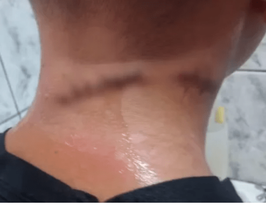 Criança de 11 anos é socorrida com ferimento no pescoço causado por linha com cerol em Piraju (SP) (Foto: Reprodução/Redes sociais)