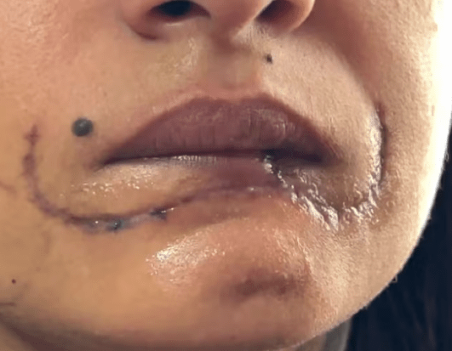 mulher-mordida-labio-ex-250324-768x413