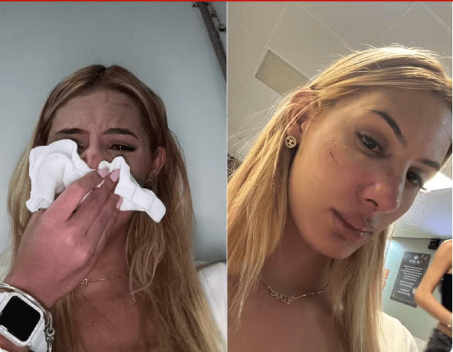 Vitoria foi agredida com um soco no nariz e denuncia que foi um ato de transfobia em Botucatu — Foto: Arquivo pessoal